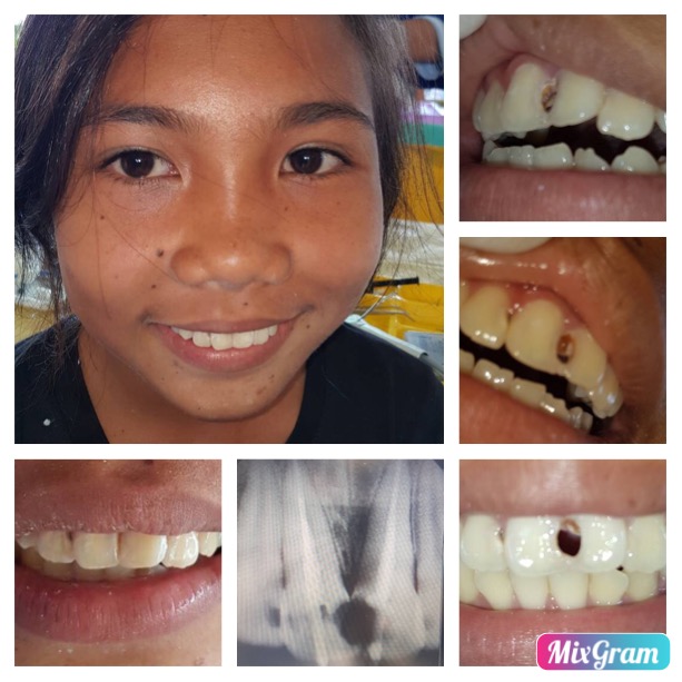 Initial ABSCBN – D4EVF Joint Dental Mission – Post Project Report